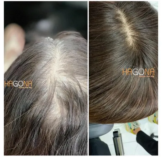 Ảnh sản phẩm Tóc giả che hói HGN H02