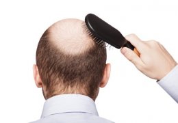 Bị hói đầu phải làm sao? Nguyên nhân, cách khắc phục