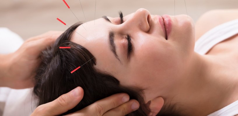 Châm cứu có thể điều trị rụng tóc hói đầu ở nam và nữ được không?