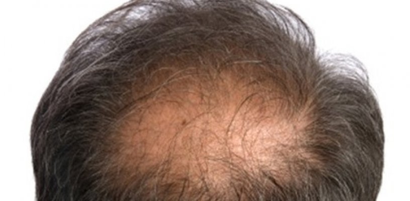 Hiện tượng rụng tóc đỉnh đầu và nguyên nhân 