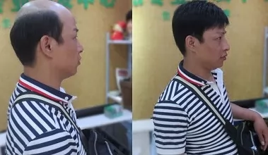Lý do nên chọn tóc mái hói nam có da đầu