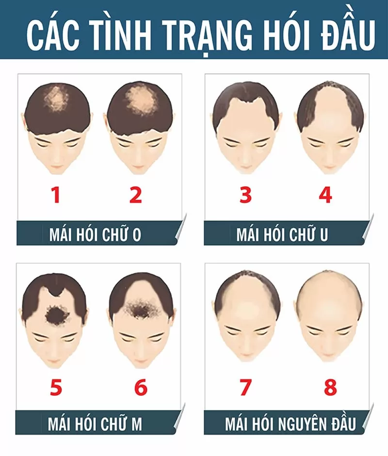 Vì sao nên sử dụng tóc giả cho người hói? 7 loại tóc giả che hói phổ biến nhất hiện nay