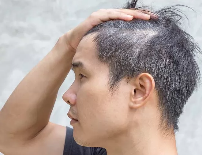 Nguyên nhân khiến tóc bạc sớm là gì? Cách khắc phục tình trạng tóc bạc sớm ở người trẻ
