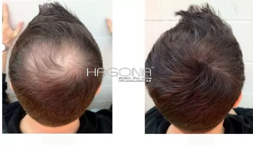 Trẻ ra 10 tuổi nhờ tóc giả cho nam đầu hói