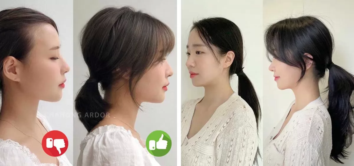 Nguyên nhân gây ra hói mái? Cách khắc phục tình trạng tóc mái bị hói 