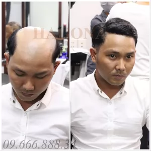 Mái hói có da đầu 1