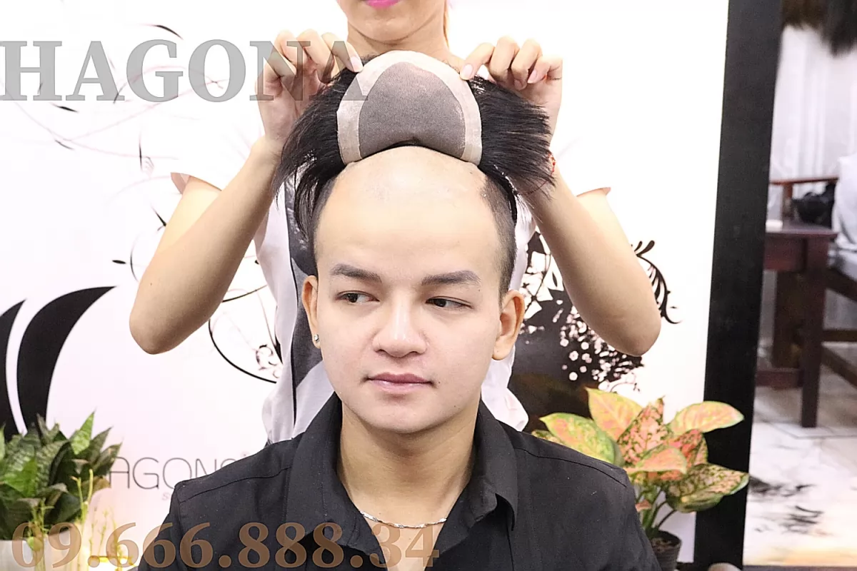 tóc mái hói nam có da đầu dạng dán
