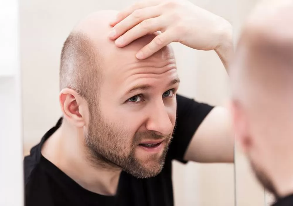 Nguyên nhân hói đầu sớm càng trở nên phổ biến?