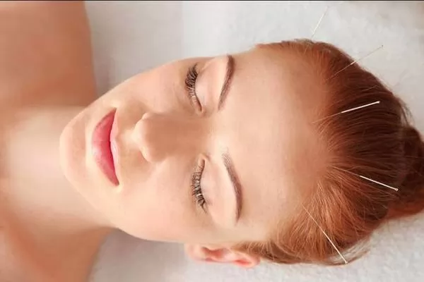 Châm cứu có thể điều trị rụng tóc hói đầu ở nam và nữ được không?