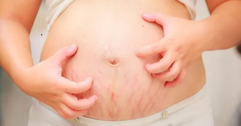 Nguyên nhân và cách điều trị ngứa da đầu khi mang thai