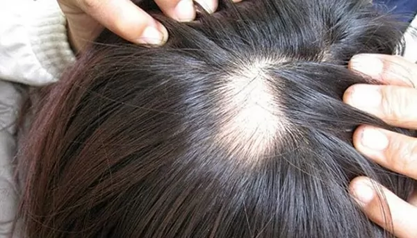rụng tóc đỉnh đầu
