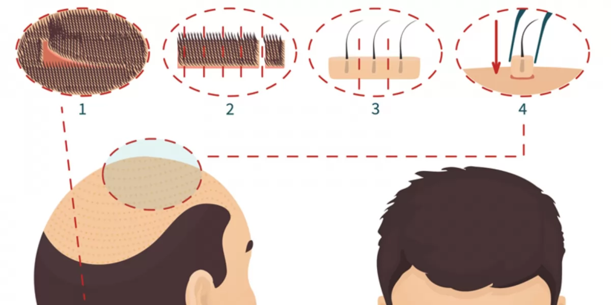 Cấy tóc là gì? Tìm hiểu chi tiết và đầy đủ trước khi thực hiện