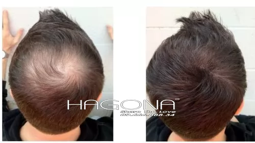 Khám phá chất liệu của các kiểu tóc dành cho nam đầu hói