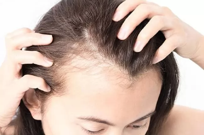 Nguyên nhân hói đầu sớm càng trở nên phổ biến?