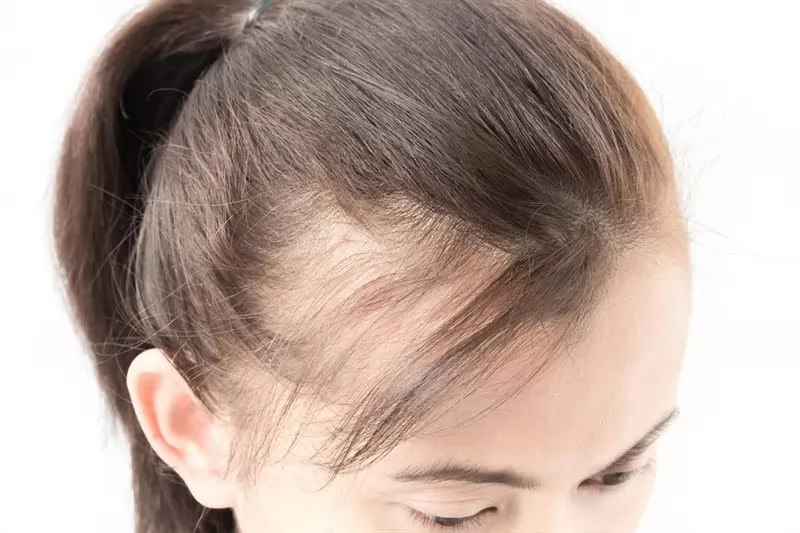 Top 7 kiểu tóc giả nữ đẹp cho người hói chữ M đang thịnh hành trong năm 2021