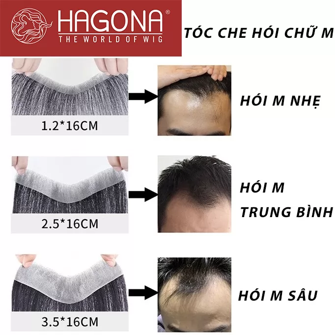 Review tóc giả mái hói chữ M cho nam trán cao của Hagona