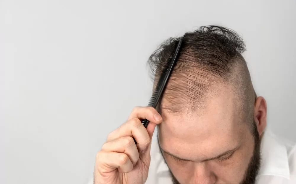 Nguyên nhân hói đầu sớm càng trở nên phổ biến?