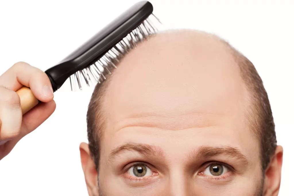 Tóc rụng nhiều ở nam giới là hiện tượng gì?