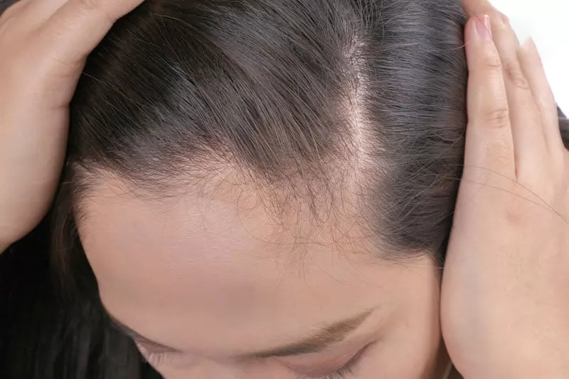 Top 7 kiểu tóc giả nữ đẹp cho người hói chữ M đang thịnh hành trong năm 2021