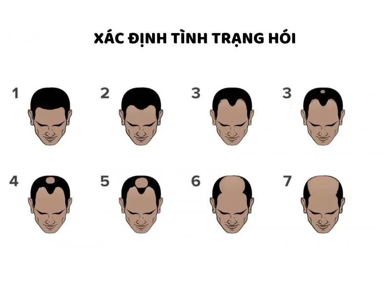 Quá trình hói tóc ở nam sẽ diễn ra như thế nào? Cách khắc phục chỉ mất 3 phút hằng ngày