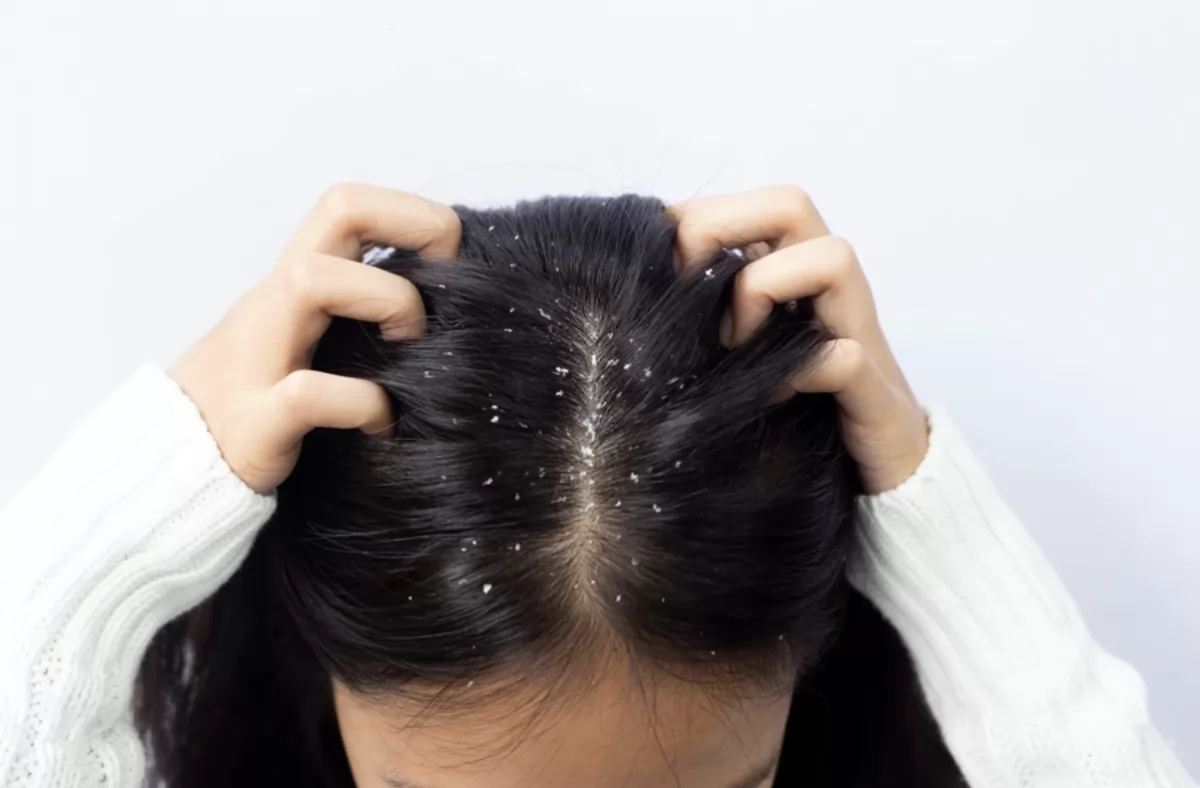 Cách trị gàu trong mùa đông hiệu quả tại nhà từ thiên nhiên
