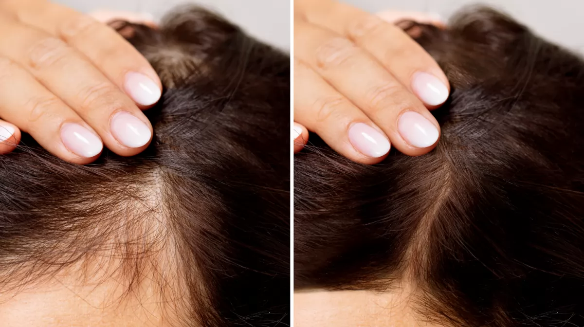 Hình minh họa vùng tóc thưa ở phụ nữ