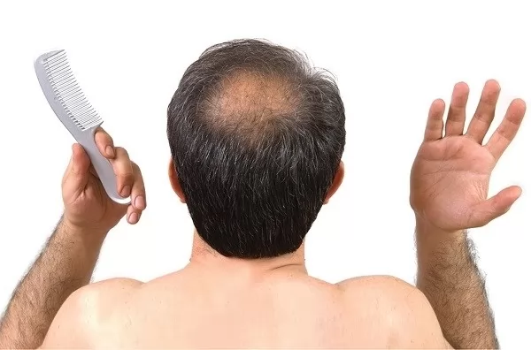 Uống rượu có phải là nguyên nhân gây rụng tóc ở nam giới?