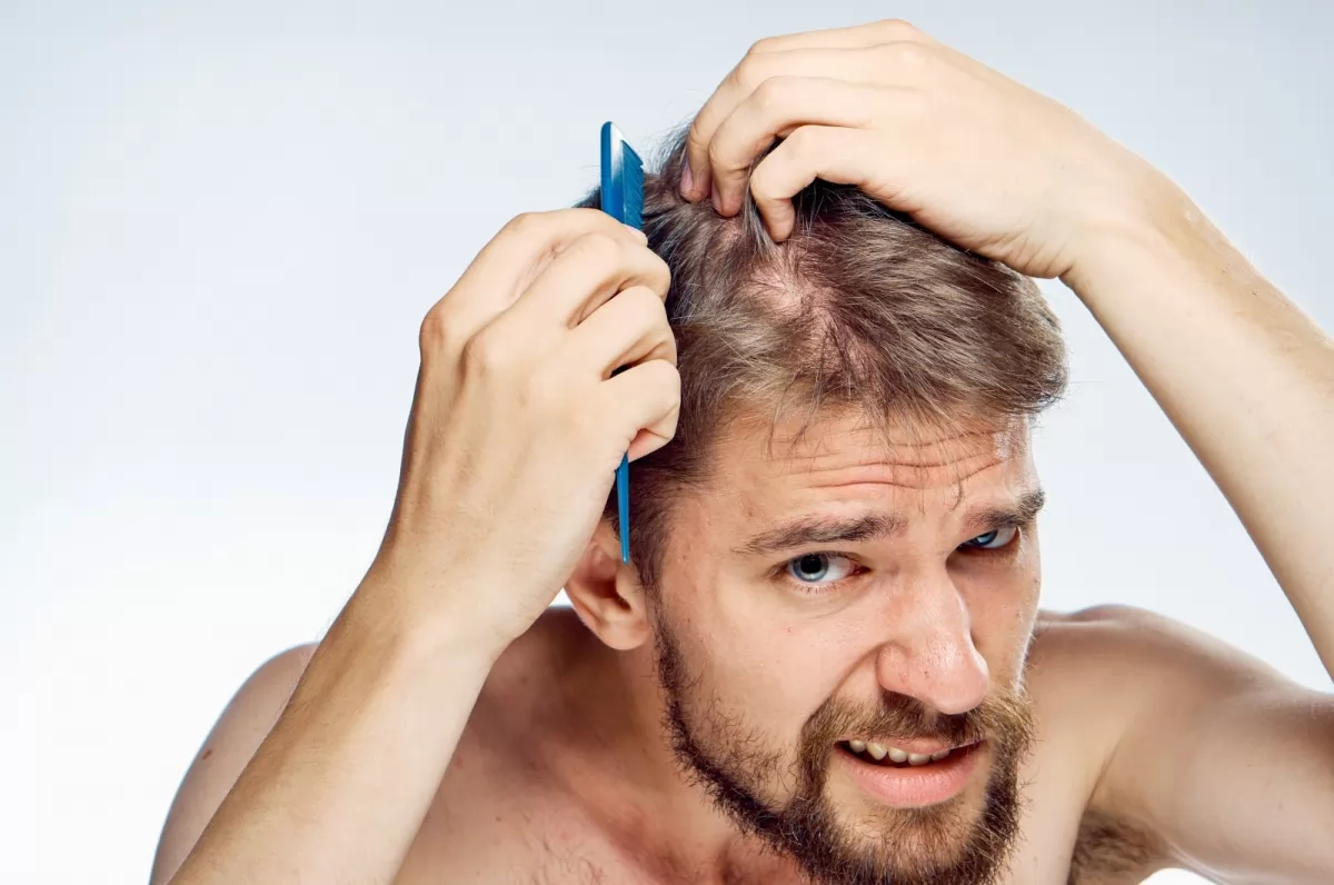 Tóc rụng nhiều ở nam giới là hiện tượng gì?