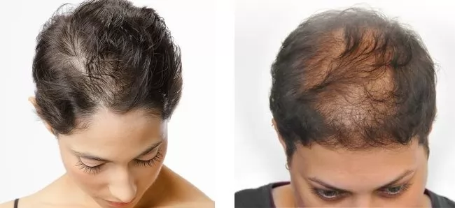 Bệnh rụng tóc là gì? Nguyên nhân và cách khắc phục tình trạng rụng tóc