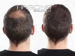 //hagona.com/tre-ra-10-tuoi-nho-toc-gia-cho-nam-dau-hoi