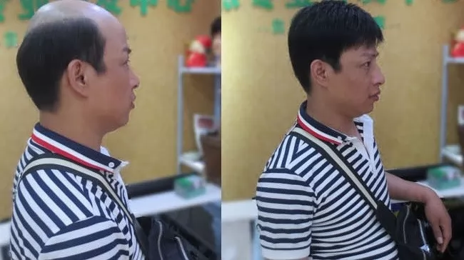 Lý do nên chọn tóc mái hói nam có da đầu