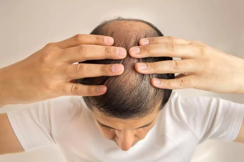 Cách ngăn ngừa rụng tóc đối đa trong thời gian hóa trị
