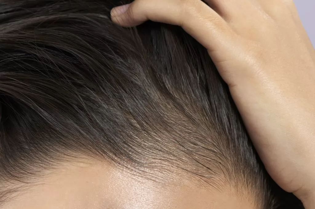 Tóc Rụng Rụng Ở Đỉnh Đầu: Nguyên Nhân Và Cách Khắc Phục