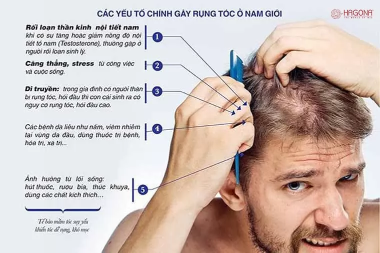 Nguyên nhân dẫn đến bệnh rụng tóc ở nam giới là gì?