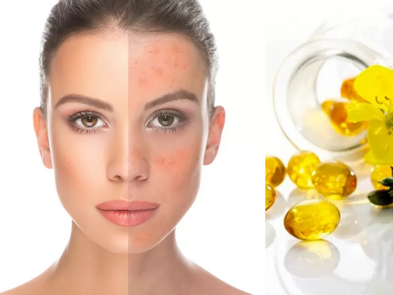 Cách sử dụng Dầu hoa anh thảo trị rụng tóc