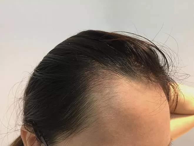 hiện tượng rụng tóc sau sinh
