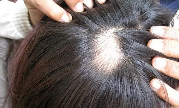 Hướng dẫn tường tận cách che tóc hói, bạn đã biết?