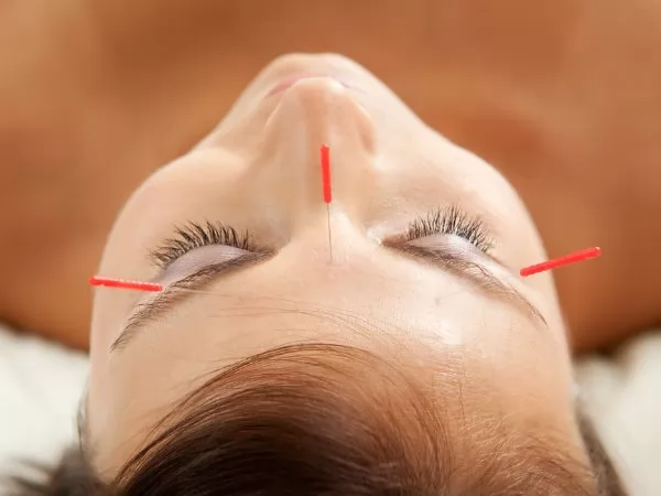 Châm cứu có thể điều trị rụng tóc hói đầu ở nam và nữ được không?