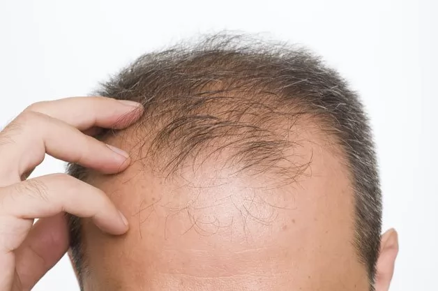 Tóc rụng nhiều ở nam giới là hiện tượng gì?
