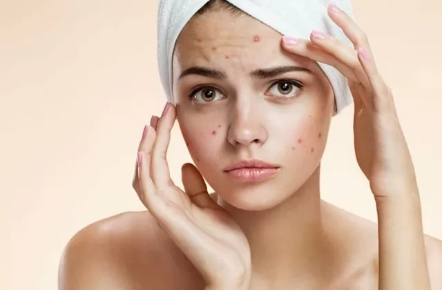 Trị gàu: 5 triệu chứng của tóc gàu và cách điều điều trị cơ bản
