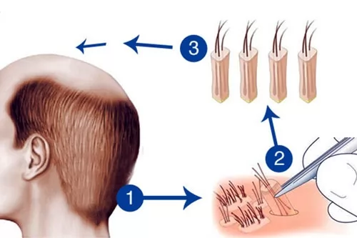 Tổng hợp các phương pháp giảm rụng tóc và kích thích mọc tóc