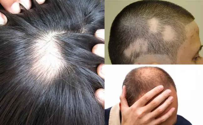 Bệnh rụng tóc là gì? Nguyên nhân và cách khắc phục tình trạng rụng tóc