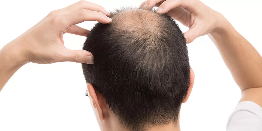 Tìm hiểu về bệnh rụng tóc ở nam giới