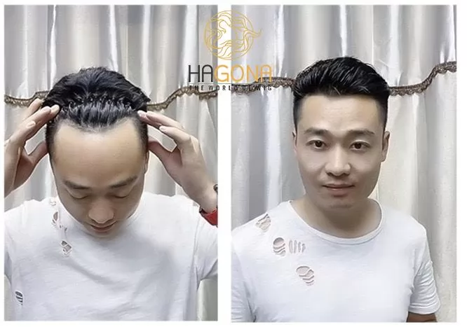 tóc giả nam cho người hói