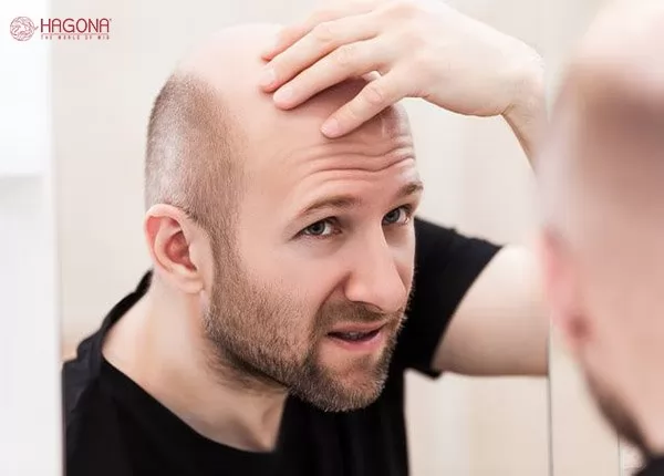 bệnh rụng tóc ở nam giới