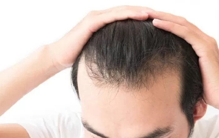 Review tóc giả mái hói chữ M cho nam trán cao của Hagona