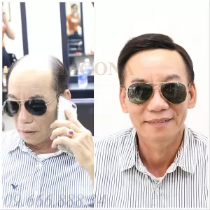 Lợi ích không ngờ tới của mái hói có da đầu