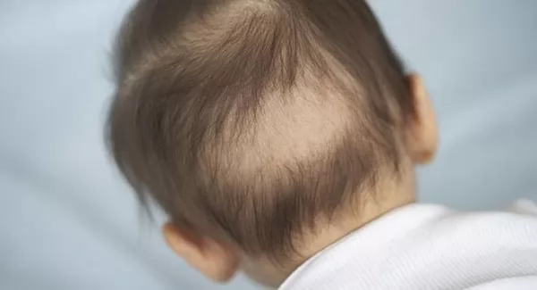 Trẻ bị rụng tóc: Nguyên nhân, triệu chứng và cách điều trị