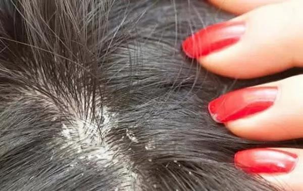 rụng tóc bất thường do bệnh
