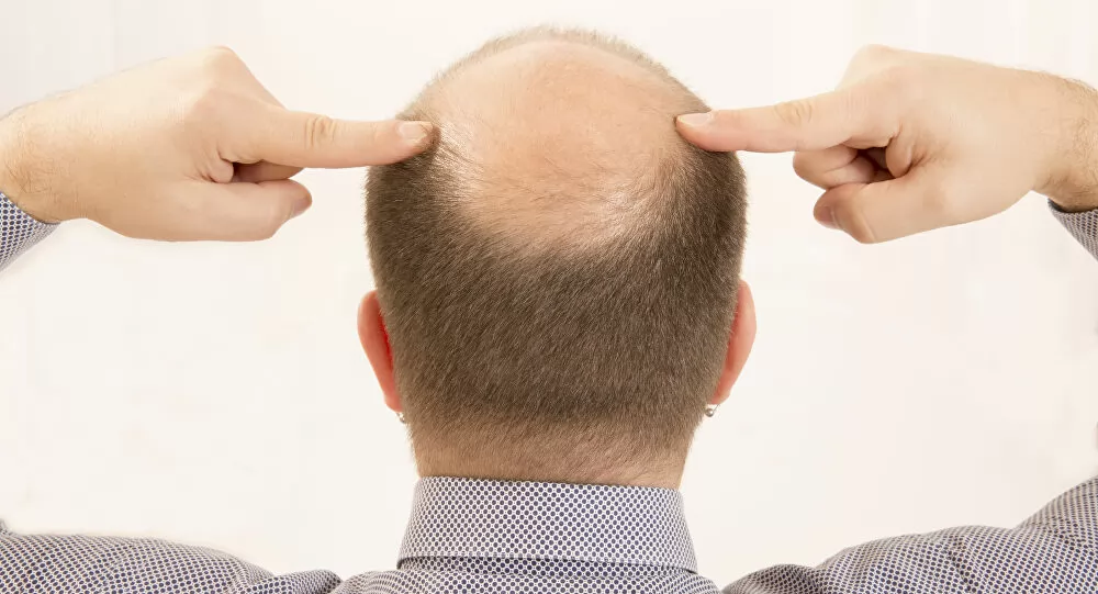 Châm cứu có thể điều trị rụng tóc hói đầu ở nam và nữ được không?
